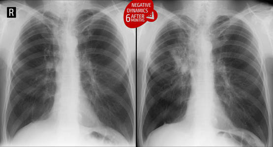 肺部X线手术肺。 肺结核在6个月后升级。