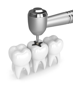 牙齿的3D渲染与牙片和钻头隔离在白色