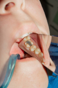 龋齿. 用拉伯填充牙科复合光聚合物材料. 牙科诊所牙科治疗的概念照片