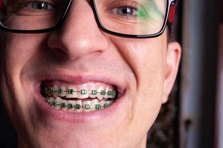 一个人的肖像，有弯曲的牙齿和金属支撑与绿色橡皮筋关闭。 带牙矫正牙套的年轻人。