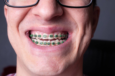 牙套和牙托在牙齿上的雄蕊学，牙齿正畸医生的麦地灵排列。