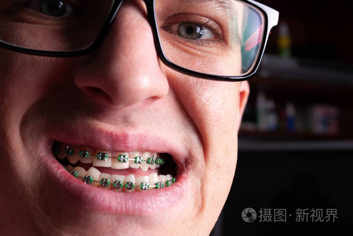 一个人的肖像 有弯曲的牙齿和金属支撑与绿色橡皮筋关闭 带牙矫正牙套的年轻人 照片 正版商用图片17d358 摄图新视界
