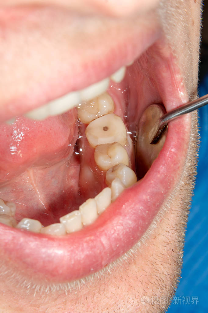 龋病治疗后上颌骨的两颗咀嚼侧牙利用橡胶坝系统用光聚合物填充材料