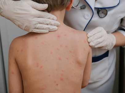 医生检查婴儿皮肤充满水泡, 疤痕和皮疹引起的水痘