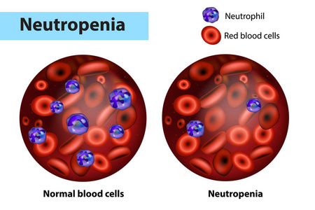 中性粒细胞减少或中性粒细胞减少和正常血细胞。