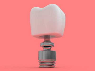 牙种植牙牙科布局塑料人牙治疗3渲染