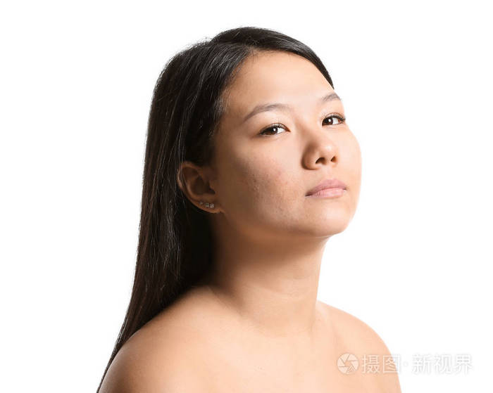 白色背景上有痤疮问题的年轻亚洲女性肖像
