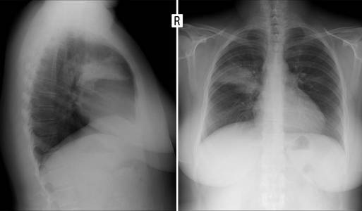 肺的X线。 肺右S2段肺炎。