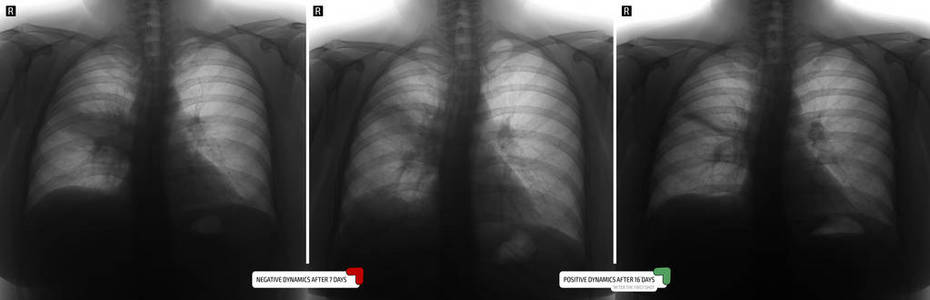 肺的X线。 肺右侧肺炎。 否定。 标记。