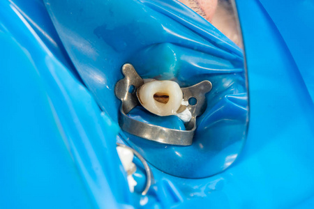 牙齿闭合的牙髓治疗。 牙齿根部的清洁及其填充。 牙科诊所的现代技术概念