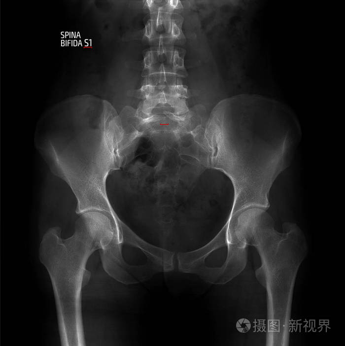 骨盆和腰骶部脊柱的x线. 脊柱裂s1. 标记.