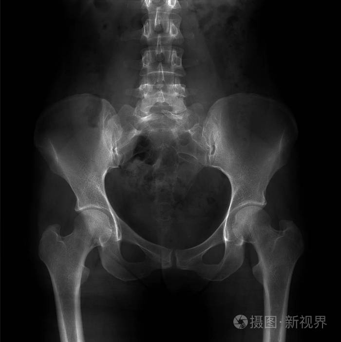 骨盆和腰骶部脊柱的x线脊柱裂s1