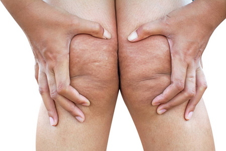女人的膝盖担心白色背景上的脂肪皮肤。