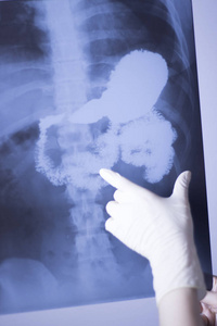 医学医院x线腰痛脊柱和髋部创伤扫描也显示胃和器官。