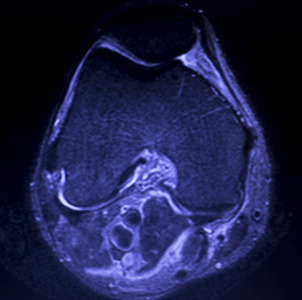 磁共振成像MRI膝后角内侧半月板撕裂最少的结果。