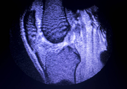 磁共振成像MRI膝后角内侧半月板撕裂最少的结果。