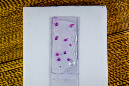 玻璃下肿瘤的切片。肿瘤细胞存在癌症的组织学检查