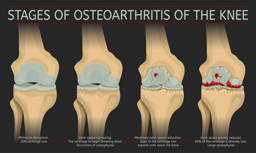 膝关节骨关节炎的阶段图片