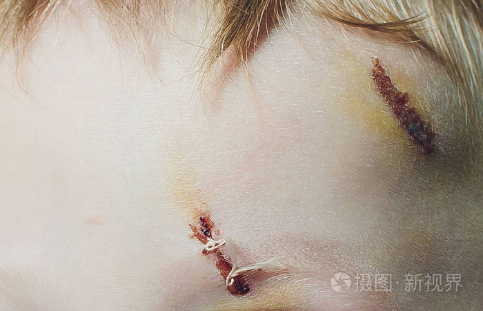 术后缝合在皮肤上没有线和碘.肌瘤切除后的疤痕.手术后缝合皮肤