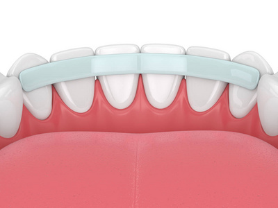 小夹板固定牙齿强化纤维在白色上的三维渲染照片