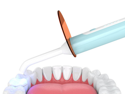 牙齿聚合灯的颌骨三维渲染和白色背景下的光固化填充