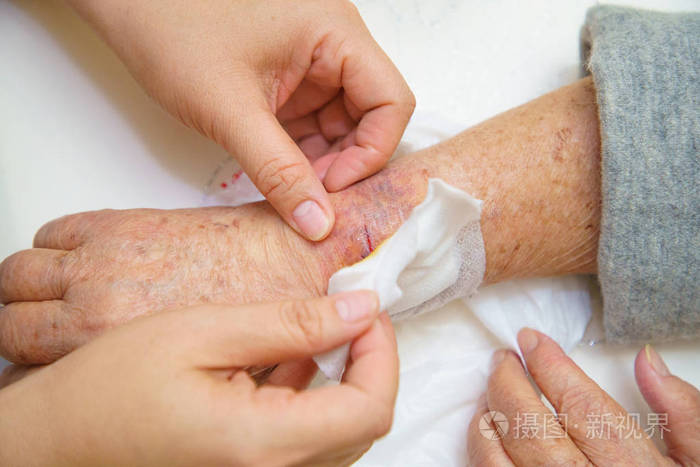 剖腹产包扎伤口用什么药水_剖腹产伤口敷料要包几天_剖腹产伤口上药
