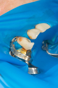 龋齿。 用拉伯填充牙科复合光聚合物材料。 牙科诊所牙科治疗的概念