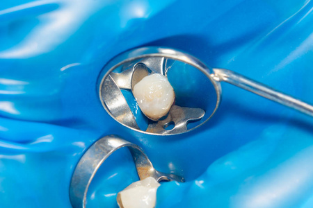 龋齿。 用拉伯填充牙科复合光聚合物材料。 牙科诊所牙科治疗的概念