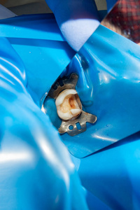 龋病治疗后上颌骨的两颗咀嚼侧牙。 利用橡胶坝系统用光聚合物填充材料修复咀嚼表面