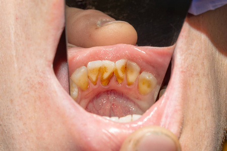 腐烂的牙齿龋齿和斑块关闭了一个不合社会的病人。 卫生和健康问题的概念