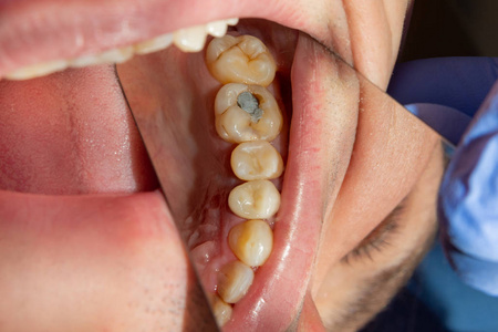 龋病治疗后上颌骨的两颗咀嚼侧牙。 利用橡胶坝系统用光聚合物填充材料修复咀嚼表面