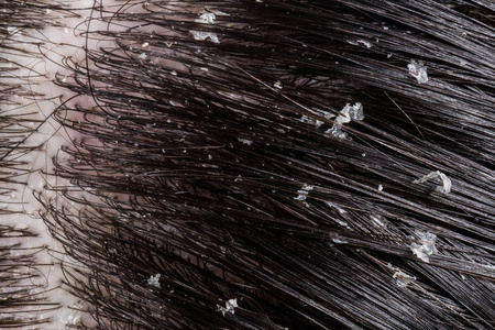 黑发上头皮干燥的问题照片