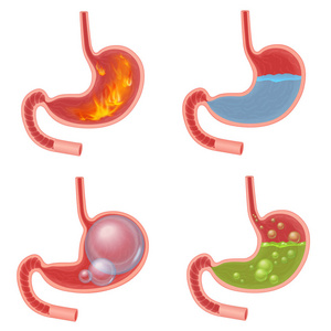 向量现实的胃医学向量例证集合。化火紊乱胃酸反流腹胀球绿色液体恶心