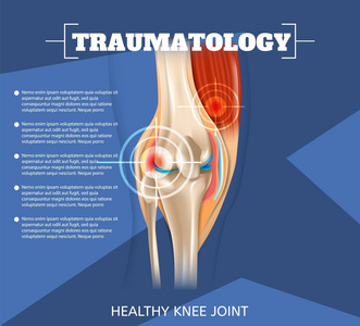 三维真实插图创伤医学。 矢量横幅图像解剖人体健康膝关节结果医疗。 信息联合治疗方法创伤专科医学