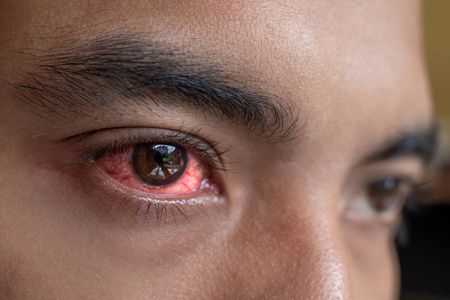 刺激的红眼需要无菌眼药水