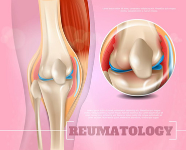 三维真实插图肿瘤医学。 横幅矢量图像特写解剖和结构人膝关节。 信息图表研究地点集中问题和疼痛导致疾病