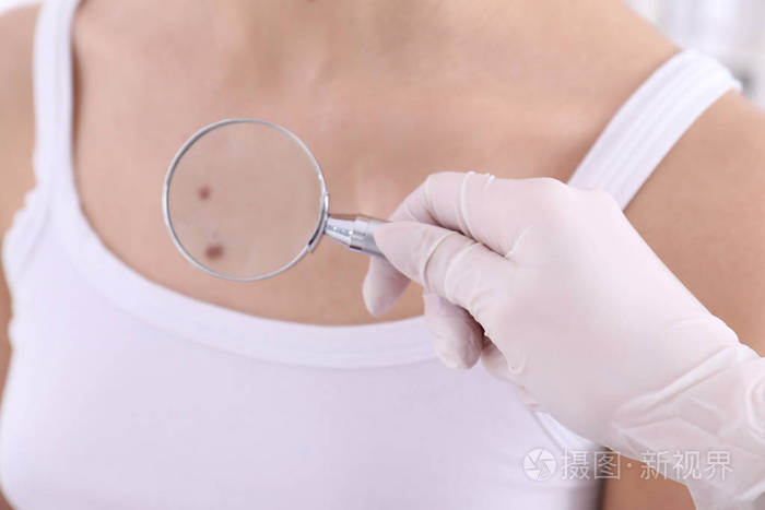 皮肤科医生检查病人放大镜在临床特写