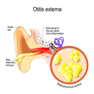 s ear. Otitis externa is inflammation of the ear canal. bacteria