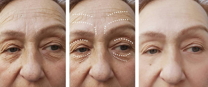 老年妇女在手术前后出现皱纹