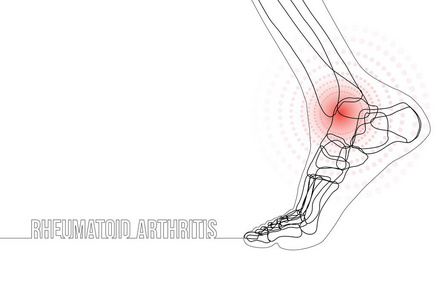 关于类风湿关节炎的连续线条绘制概念横幅