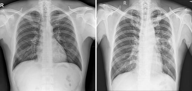 胸部x线2视图显示胸部正常及异常