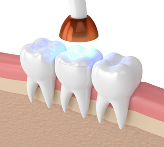 牙齿聚合灯的三维渲染和白色背景下的光固化填充