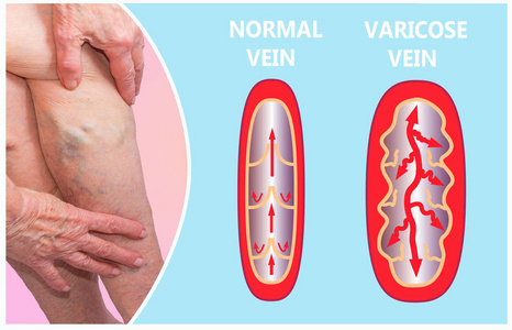 女性的高级腿上的静脉曲张。正常和静脉曲张的结构