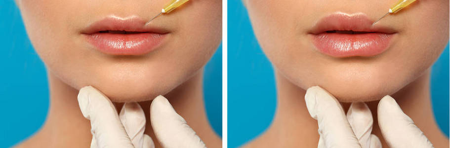 美容师在彩色背景特写上进行嘴唇注射。 妇女在隆术前后