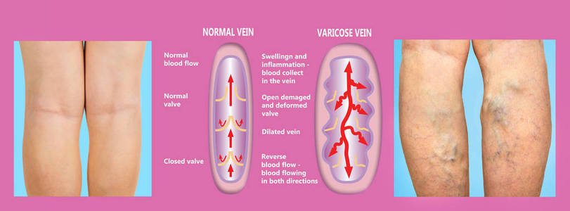 女性的高级腿上的静脉曲张。正常和静脉曲张的结构