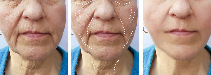 老年妇女在治疗前后出现皱纹
