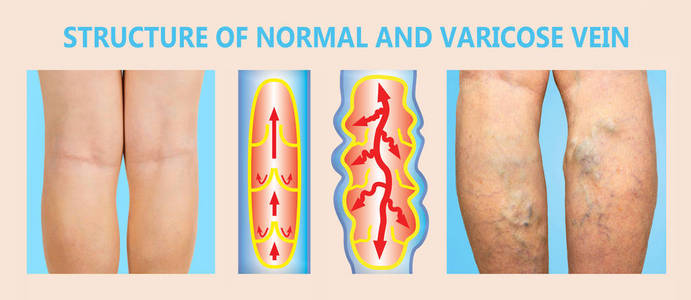 女性的高级腿上的静脉曲张。正常和静脉曲张的结构