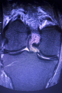 磁共振成像MRI膝后角内侧半月板撕裂最少的结果。