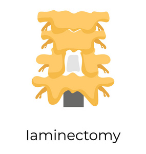 椎板切除手术切除骨弓
