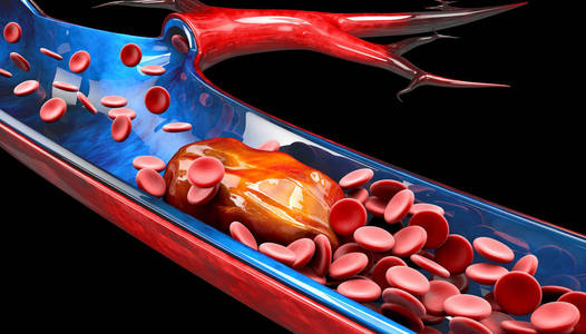 深静脉血栓形成或血块的三维图示。 栓塞